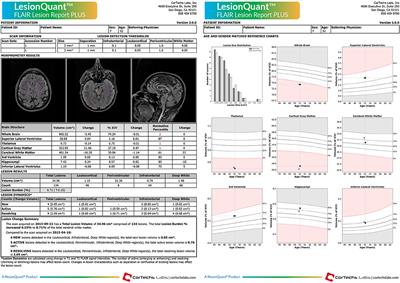 LesionQuant for Assessment of MRI in Multiple Sclerosis—A Promising Supplement to the Visual Scan Inspection